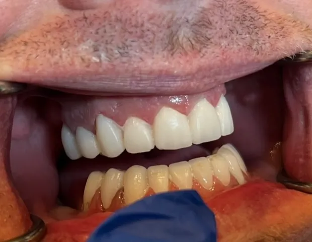 After image of dental treatment