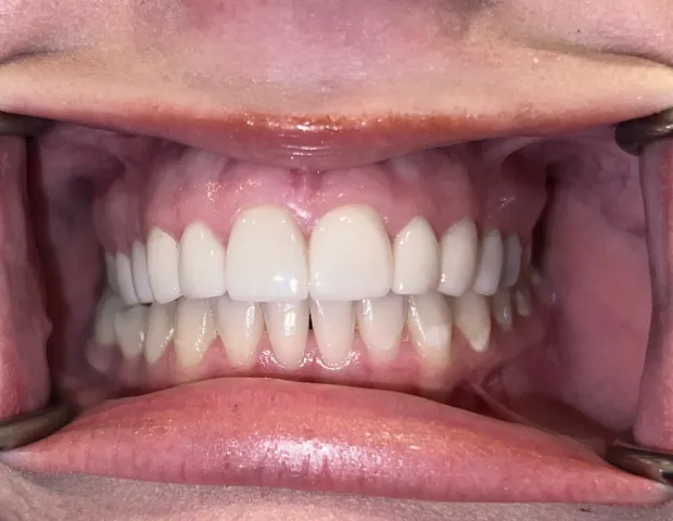 After image of dental treatment