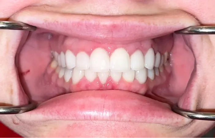 After image of dental treatment